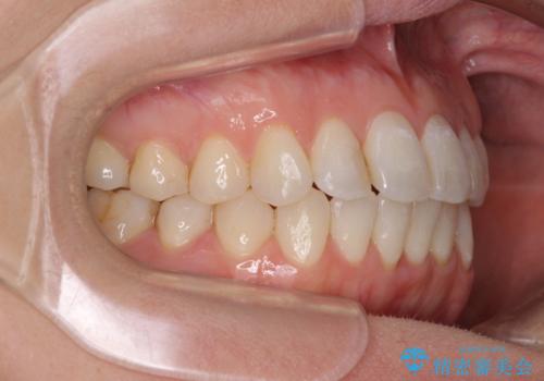 長年気にしていた前歯 インビザラインで目立たず改善の治療中