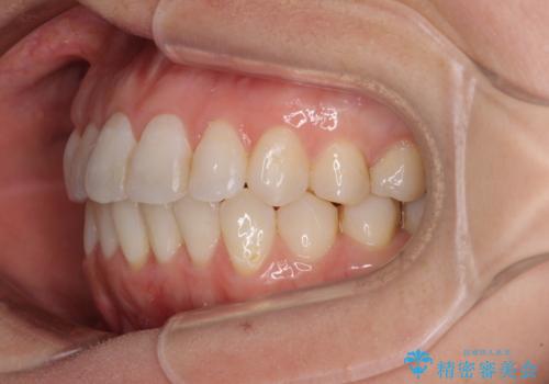 長年気にしていた前歯 インビザラインで目立たず改善の治療中