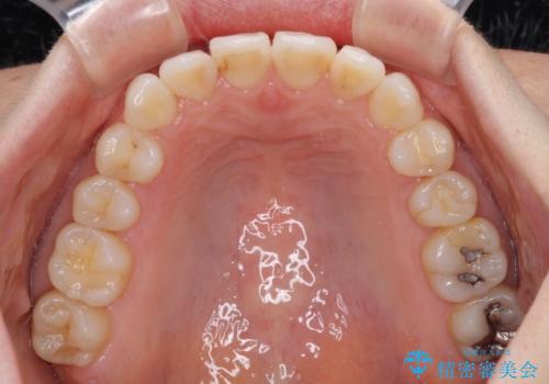 長年気にしていた前歯 インビザラインで目立たず改善の治療中