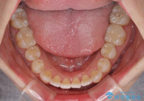 長年気にしていた前歯 インビザラインで目立たず改善の治療中