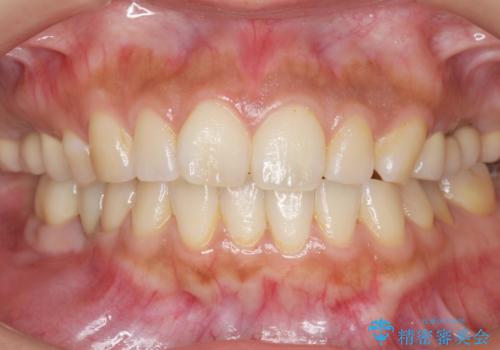 歯が折れた 低予算でオールセラミックのブリッジ 20代女性の治療後