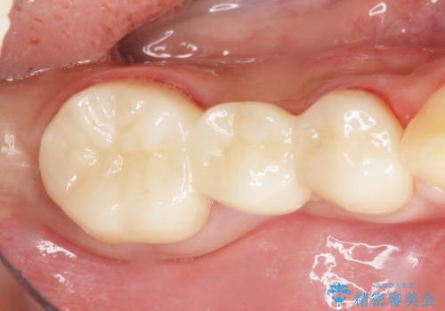 歯が折れた 低予算でオールセラミックのブリッジ 20代女性の治療後