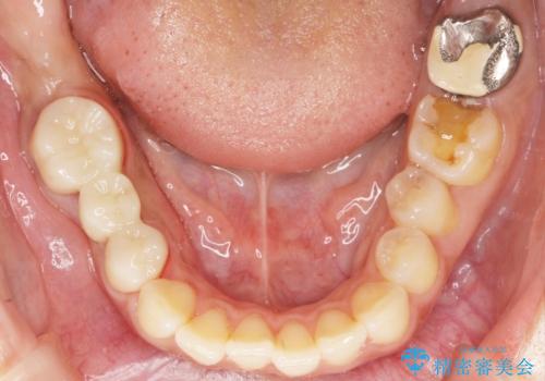 歯が折れた 低予算でオールセラミックのブリッジ 20代女性の治療後