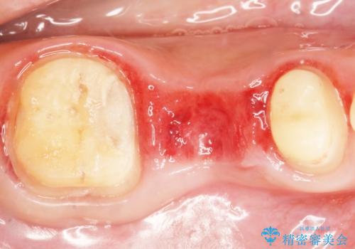 歯が折れた 低予算でオールセラミックのブリッジ 20代女性の治療中