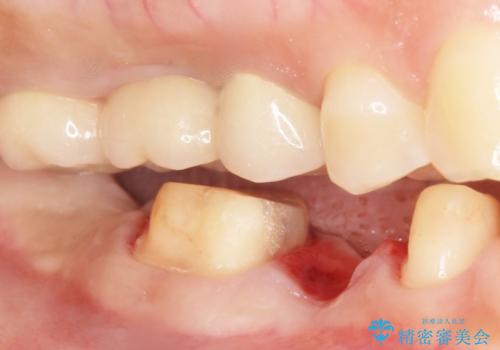 歯が折れた 低予算でオールセラミックのブリッジ 20代女性の治療中