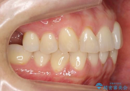 前歯が反対になっている マウスピース矯正+奥歯ブリッジの治療前
