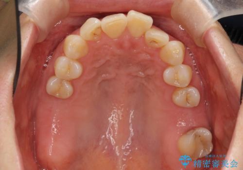 前歯が反対になっている マウスピース矯正+奥歯ブリッジの治療前