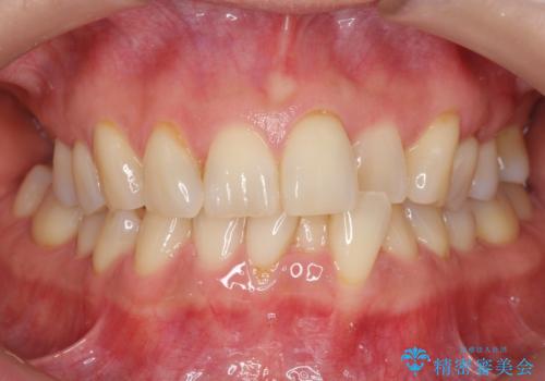 前歯が反対になっている　マウスピース矯正+奥歯ブリッジの症例 治療前