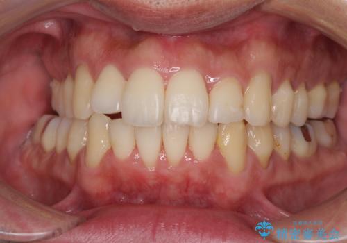 下顎骨が顕著に右側にずれている インビザラインによる咬合改善の治療中