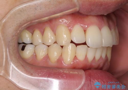 下顎骨が顕著に右側にずれている インビザラインによる咬合改善の治療中