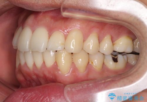 下顎骨が顕著に右側にずれている インビザラインによる咬合改善の治療中