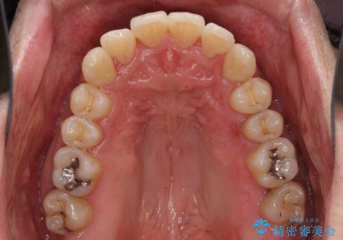 下顎骨が顕著に右側にずれている インビザラインによる咬合改善の治療中