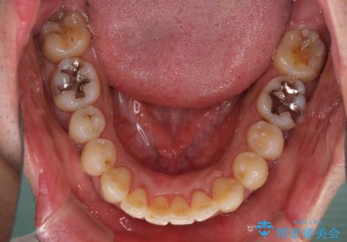 下顎骨が顕著に右側にずれている インビザラインによる咬合改善の治療中