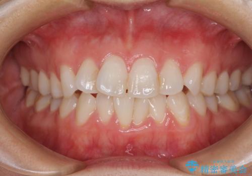 長年気にしていた前歯 インビザラインで目立たず改善の治療前