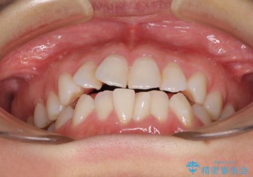 長年気にしていた前歯 インビザラインで目立たず改善の治療前