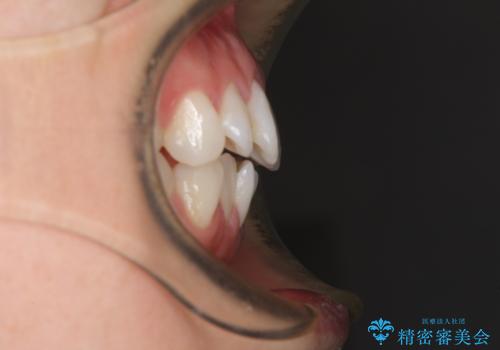 長年気にしていた前歯 インビザラインで目立たず改善の治療前