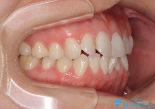 長年気にしていた前歯 インビザラインで目立たず改善の治療前