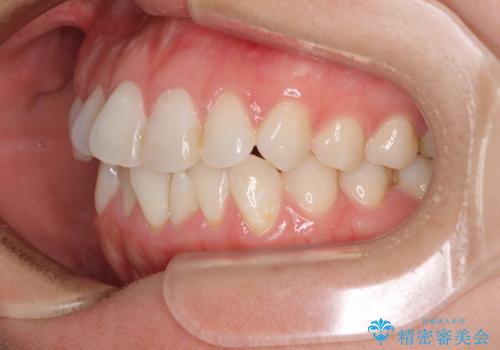 長年気にしていた前歯 インビザラインで目立たず改善の治療前