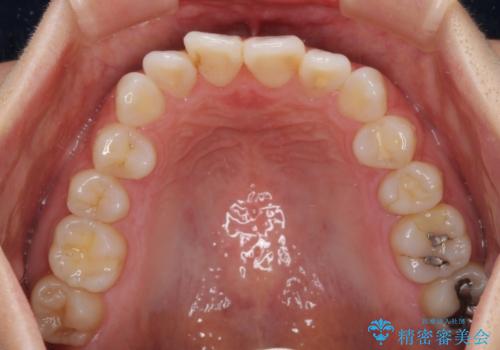 長年気にしていた前歯 インビザラインで目立たず改善の治療前