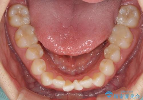 長年気にしていた前歯 インビザラインで目立たず改善の治療前