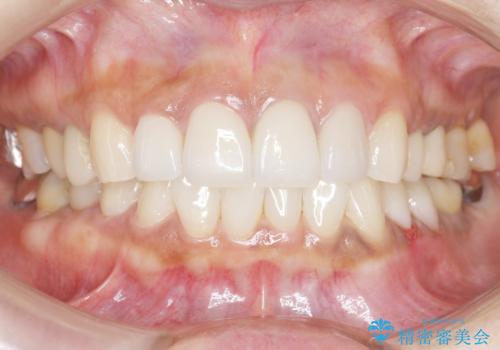 長持ちするセラミック 5年経過症例 50代女性の治療後