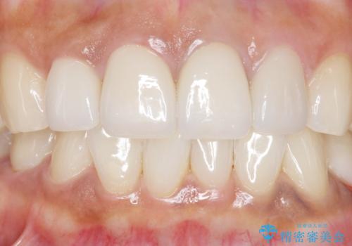 長持ちするセラミック 5年経過症例 50代女性の治療後