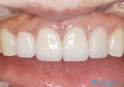 長持ちするセラミック 5年経過症例 50代女性の治療後