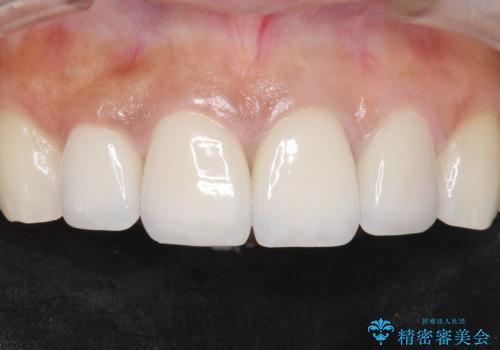 長持ちするセラミック 5年経過症例 50代女性の症例 治療後