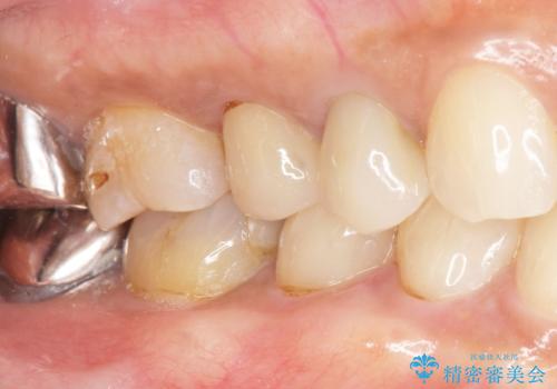 歯が欠けて舌が引っかかる セラミックインレー 50代女性の治療後