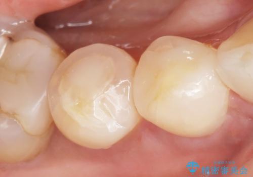 歯が欠けて舌が引っかかる　セラミックインレー　50代女性の症例 治療後