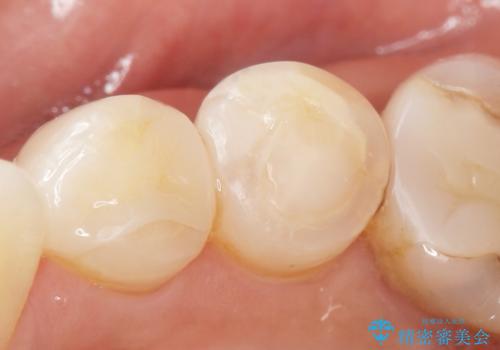歯が欠けて舌が引っかかる セラミックインレー 50代女性の治療後