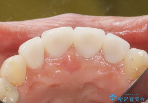 長持ちするセラミック 5年経過症例 50代女性の治療後
