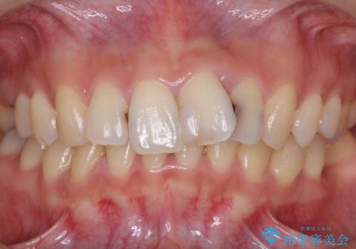 前歯をきれいにしたい 20代女性の治療前