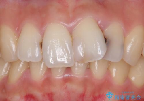 前歯をきれいにしたい 20代女性の治療前
