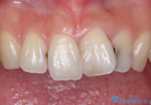 前歯をきれいにしたい 20代女性の治療前