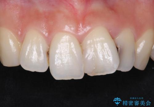前歯をきれいにしたい 20代女性の症例 治療前