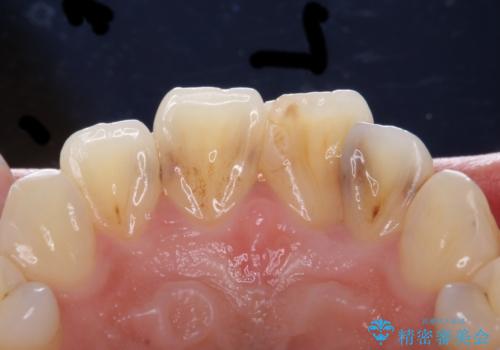 前歯をきれいにしたい 20代女性の治療前