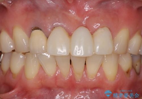 抜かなければいけない前歯 歯肉移植を用いたオールセラミックブリッジの治療中