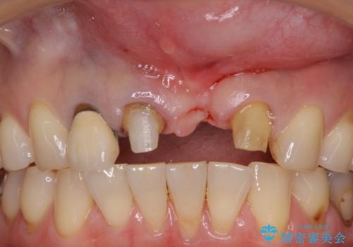 抜かなければいけない前歯 歯肉移植を用いたオールセラミックブリッジの治療中