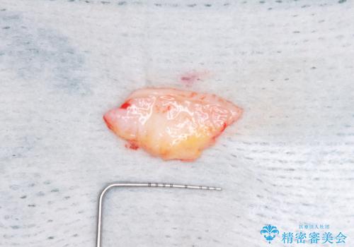 抜かなければいけない前歯 歯肉移植を用いたオールセラミックブリッジの治療中