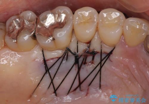 抜かなければいけない前歯 歯肉移植を用いたオールセラミックブリッジの治療後