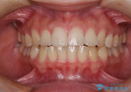 転倒して欠けてしまった前歯をオールセラミッククラウンで自然な口元にの治療前