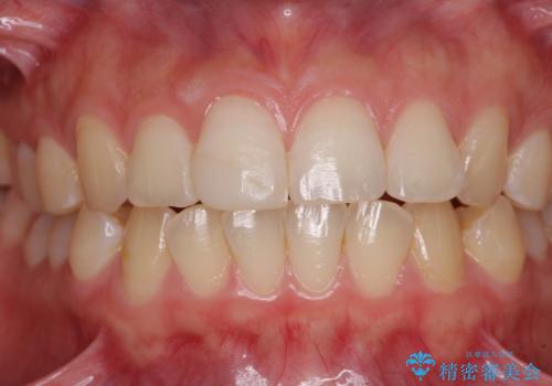 転倒して欠けてしまった前歯をオールセラミッククラウンで自然な口元にの治療前