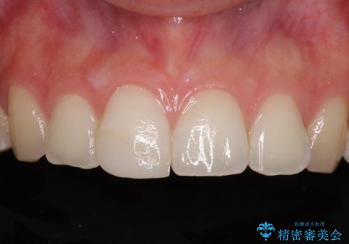 転倒して欠けてしまった前歯をオールセラミッククラウンで自然な口元にの症例 治療前