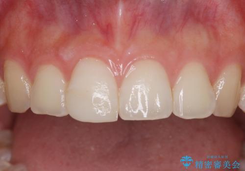 転倒して欠けてしまった前歯をオールセラミッククラウンで自然な口元にの治療前