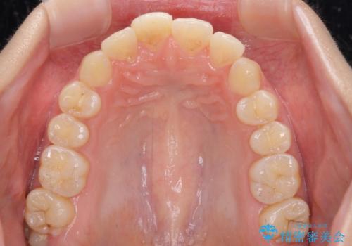 転倒して欠けてしまった前歯をオールセラミッククラウンで自然な口元にの治療前