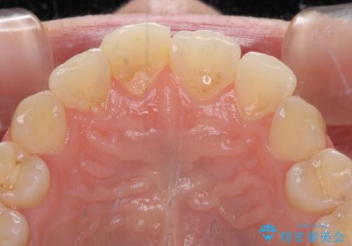 転倒して欠けてしまった前歯をオールセラミッククラウンで自然な口元にの治療前