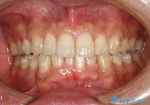 再矯正、後戻りを治したい、マウスピース矯正の治療中