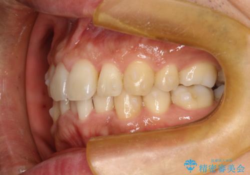 再矯正、後戻りを治したい、マウスピース矯正の治療中
