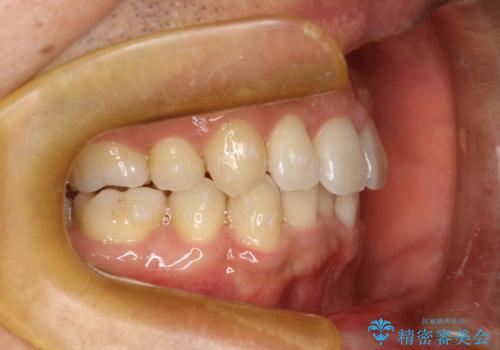 再矯正、後戻りを治したい、マウスピース矯正の治療中